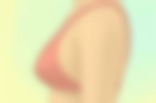 肚子抽脂会导致皮肤松弛下垂吗？