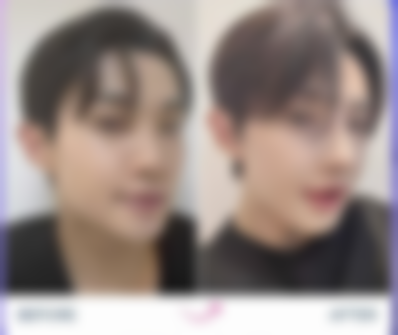 除了冰敷还有什么消除眼袋的方法