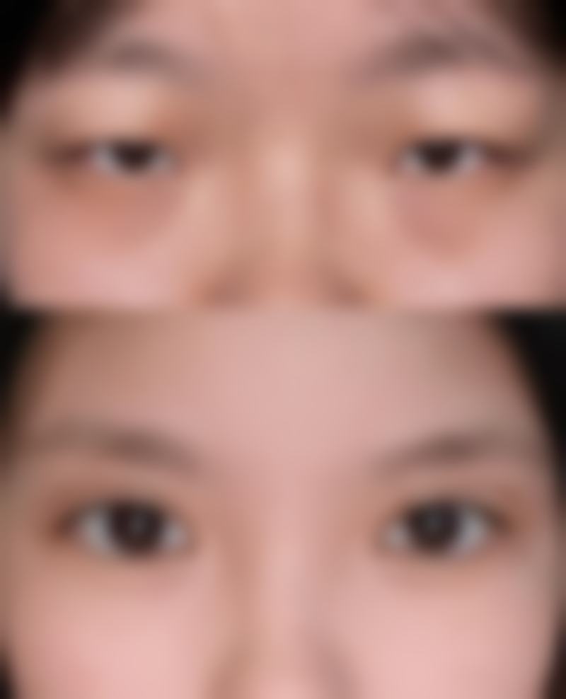 肚子抽脂引发感染的可能性大吗？