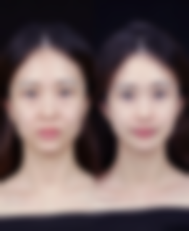 做完双眼皮后饮食上还有哪些注意事项