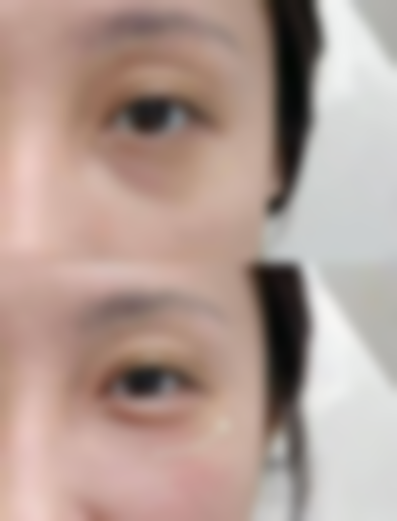 蓝莓对做完双眼皮后的修复有什么帮助