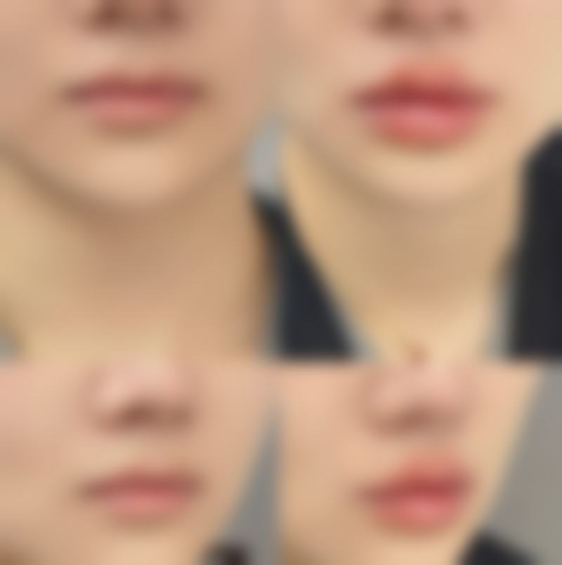 冰敷消除眼袋值不值