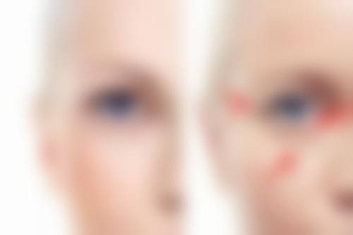 如何避免肋骨隆鼻钙化移位变形