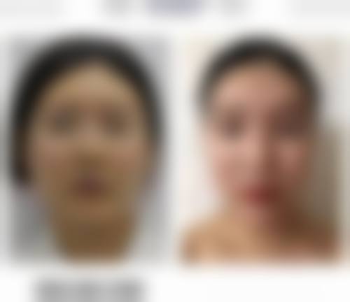 做双眼皮提肌值不值