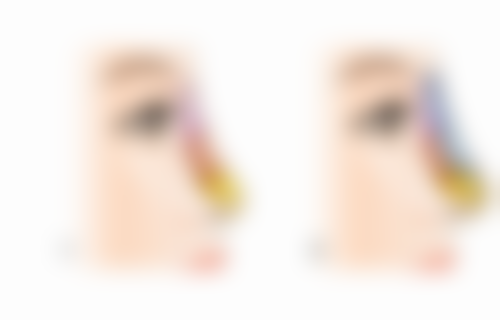 瘦脸针国产衡力维持时间久吗？