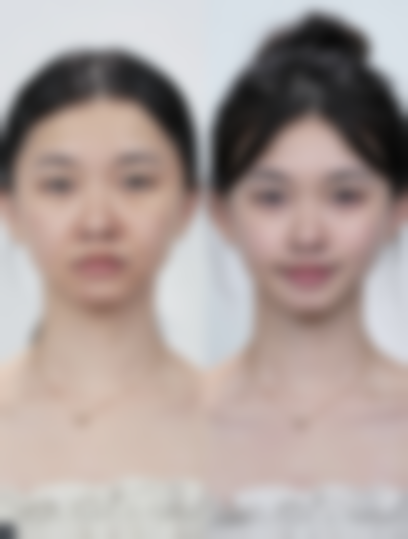 激光修复面部疤痕凹陷成效怎么样