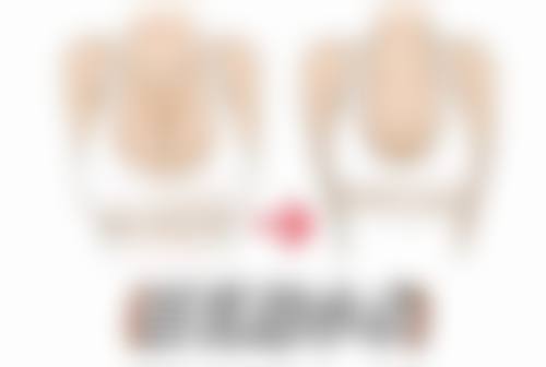 眼角下垂做双眼皮值不值