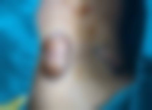 微晶磨皮处理疤痕疙瘩适合吗