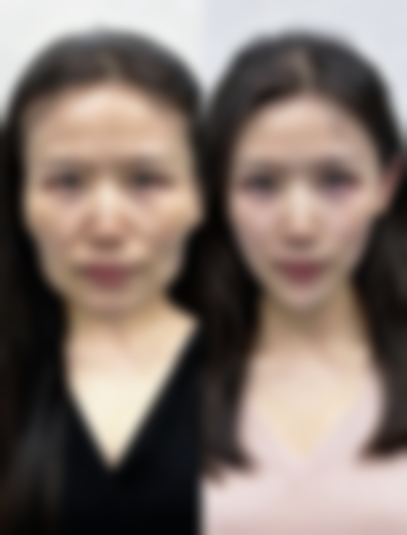 注射治疗处理疤痕疙瘩值不值