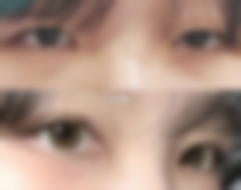 武汉斯启诺医美眼部整形的成功实例