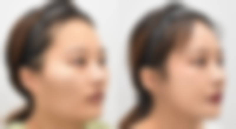 硅胶隆鼻适合哪些人群？