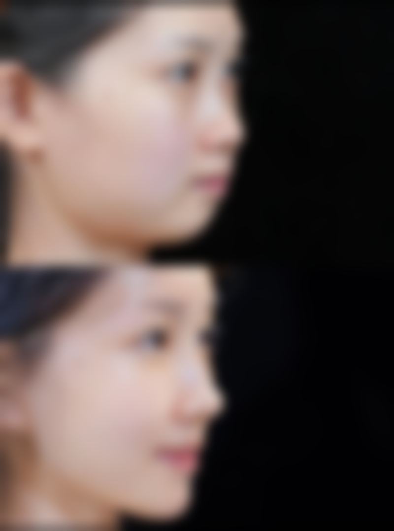 医美激光祛疤和微晶磨皮术联合去除黑的疤痕成效值不值