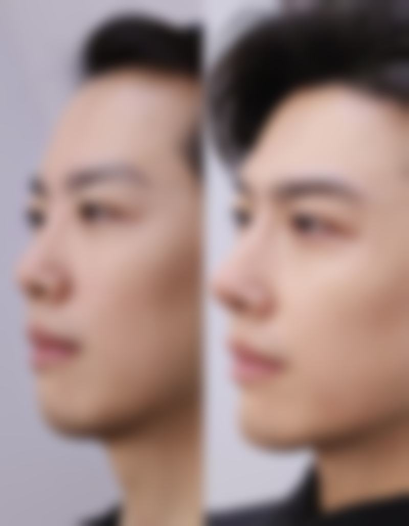 烫伤疤痕印去掉后会复发吗