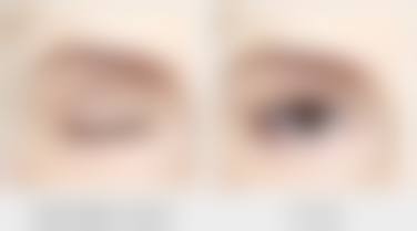 填充治疗凹陷疤痕成效怎么样