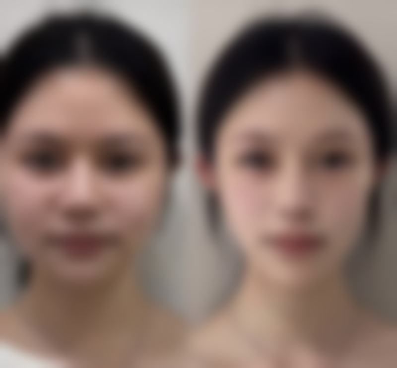 隆鼻后鼻头红点一直不消会自己消失吗