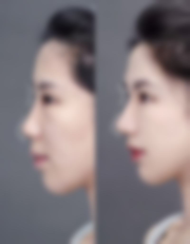 广州妃整形医院真实实例:见证美丽蜕变