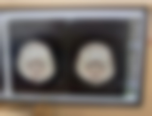 硅胶隆鼻1 - 3个月完全消肿自然适合所有人吗