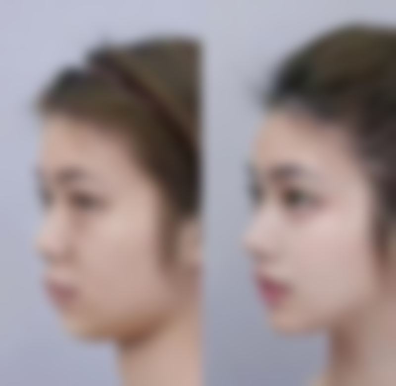 50岁隆胸后如何护理？