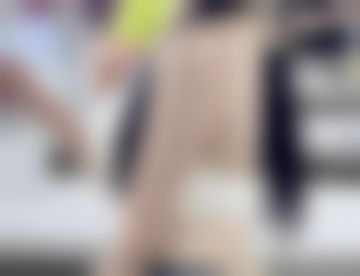 五官协调性怎么帮助判断适不适合双眼皮