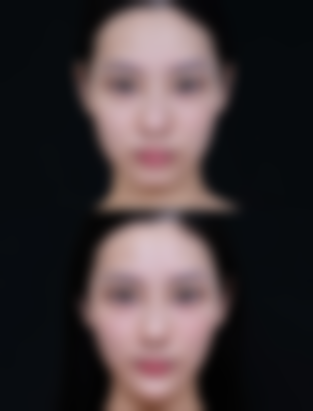 韩国摩兹（modsclinic）整形医院真实实例