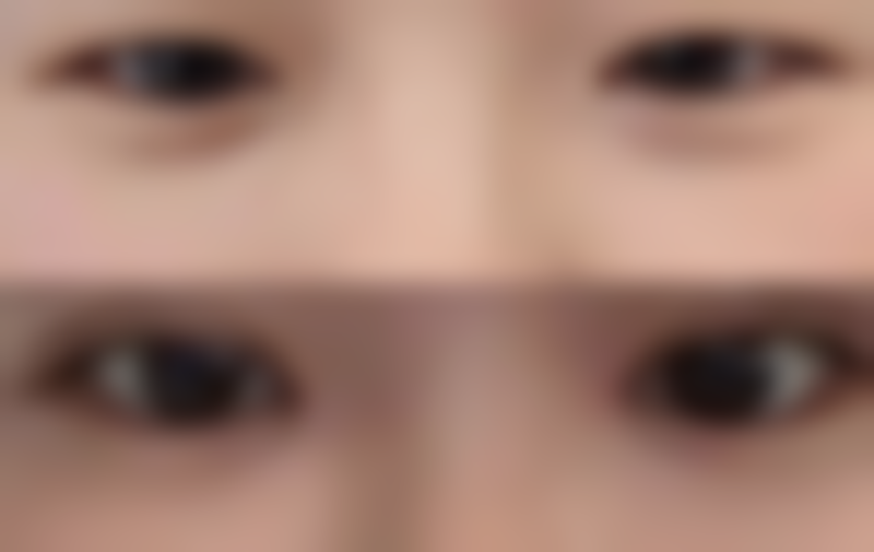 多磺酸粘多糖乳膏对手术疤痕痒止痒成效怎么样