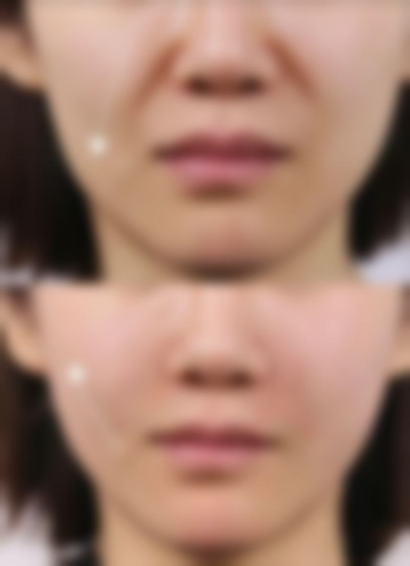 如何判断抽脂后是否可以喝酒