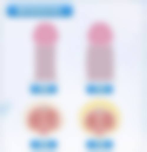 抽脂真的能帮助快速拥有好身材吗