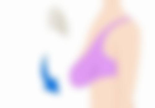 外切眼袋出现感染的危害大吗