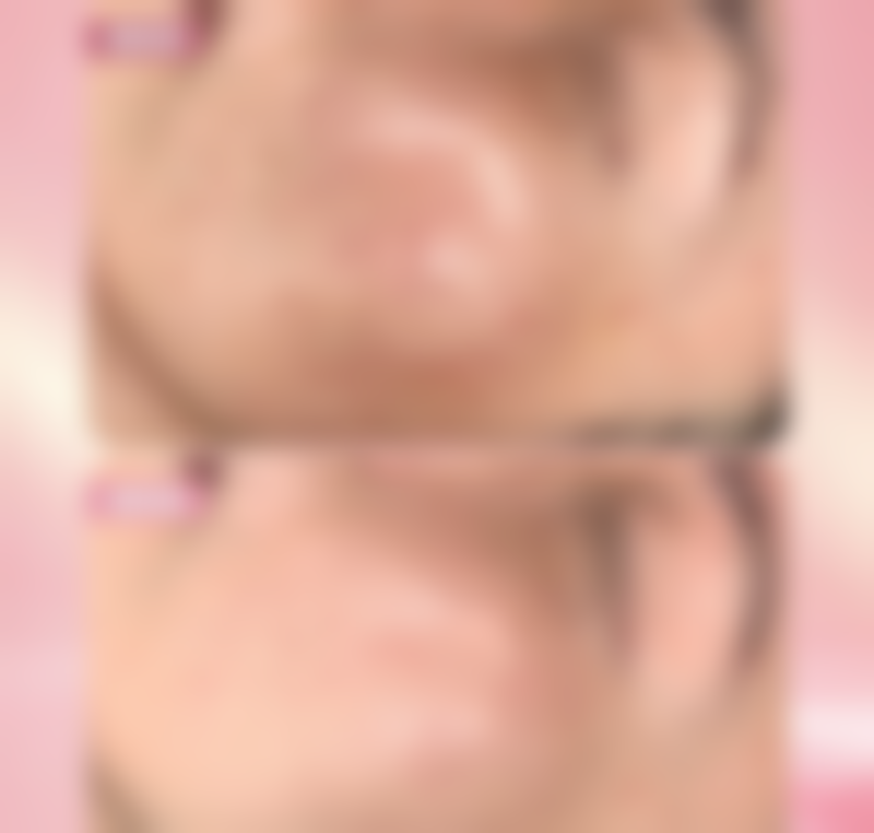 个人体质对割双眼皮修复时间有什么影响?