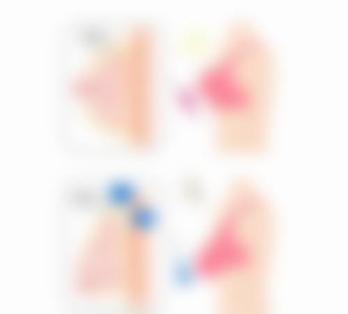 哪些因素会影响埋线双眼皮保持时间