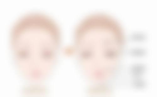 玻尿酸除皱针能解决面部哪些问题?