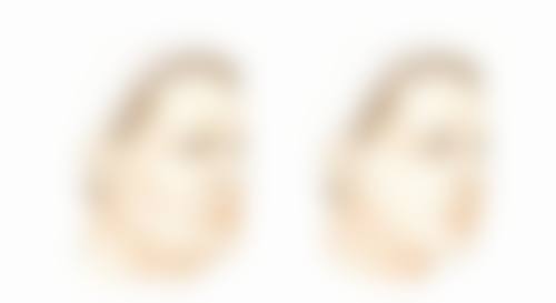 30G - 32G、4 - 6mm的针头打瘦脸针怎么样