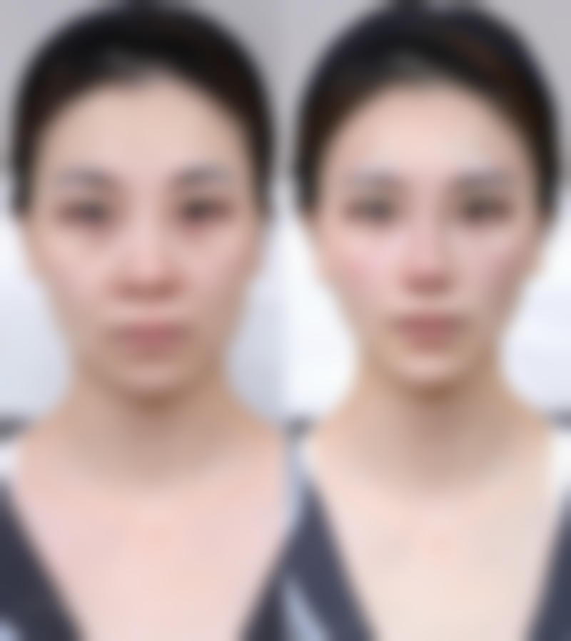 射频治疗消除大眼袋靠谱吗?