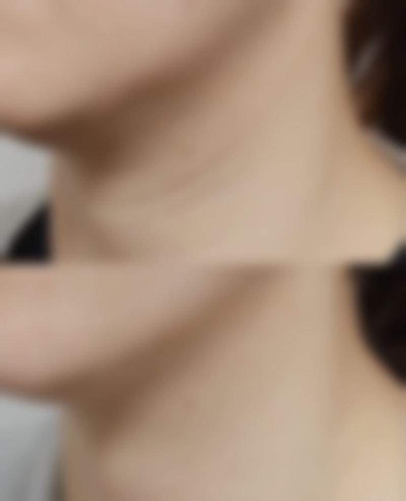 打瘦脸针用不同长度针头的成效差异大吗