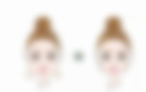 割双眼皮后消肿慢正常吗