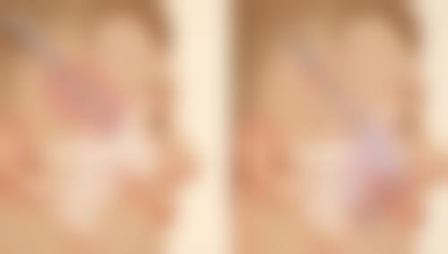 手术切除联合放疗治疗胸口疤痕疙瘩怎么样