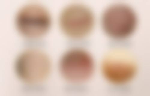 割双眼皮后不同阶段的消肿表现是怎样的