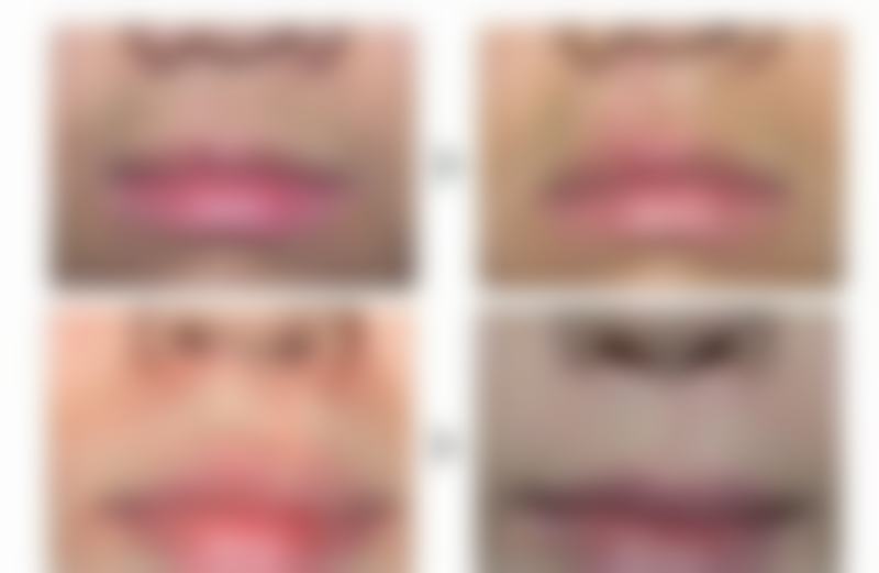 成都恒美医疗美容门诊部真实实例：见证毛发奇迹