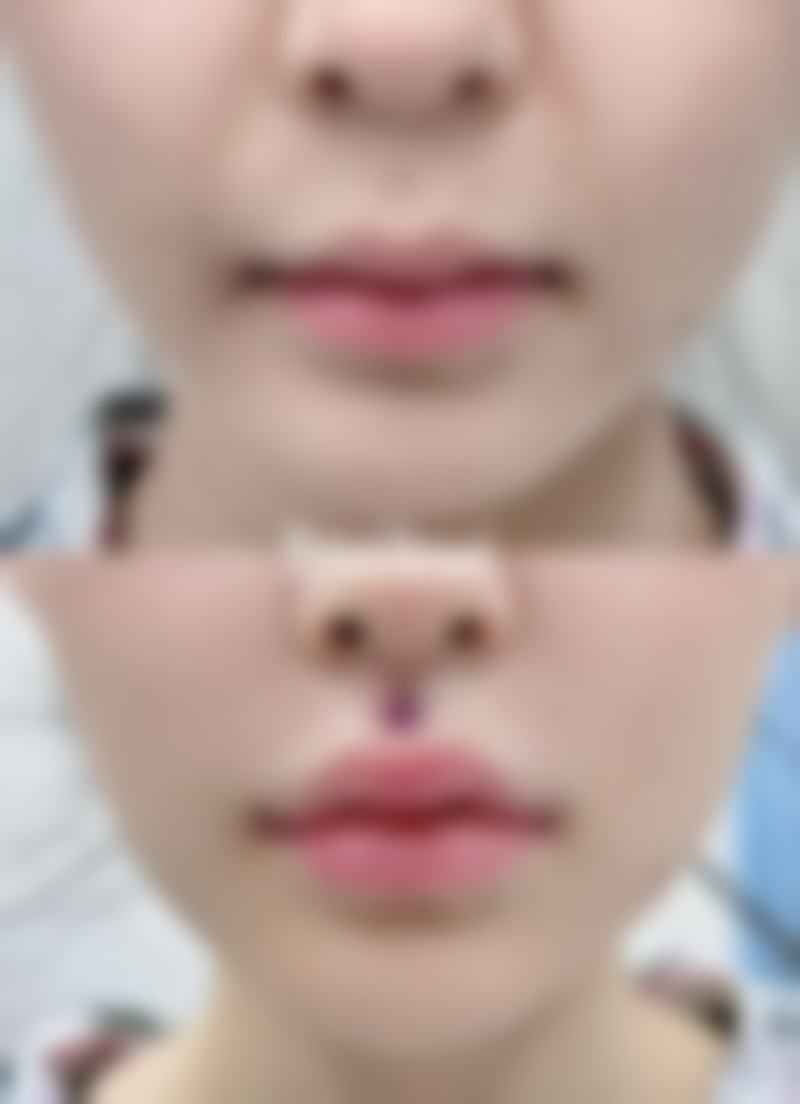 使用艾条去除眼袋要注意什么