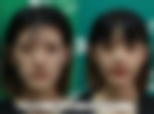 选择医美方法解决眼袋增生修复正常靠谱吗