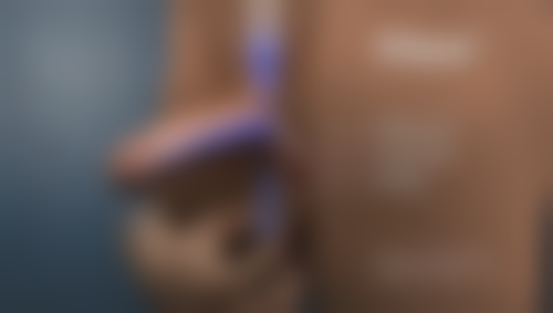 压力疗法适合眼袋手术后疤痕吗