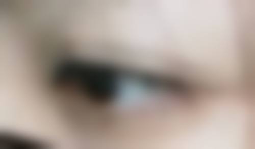 割双眼皮术后护理防感染重要吗？