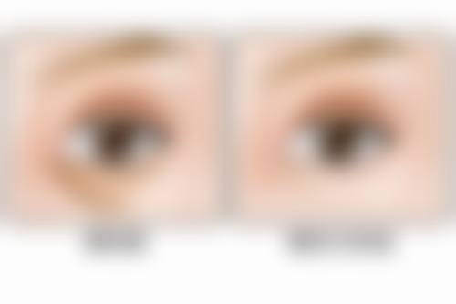 哪些医美方法能帮助眼袋增生修复正常