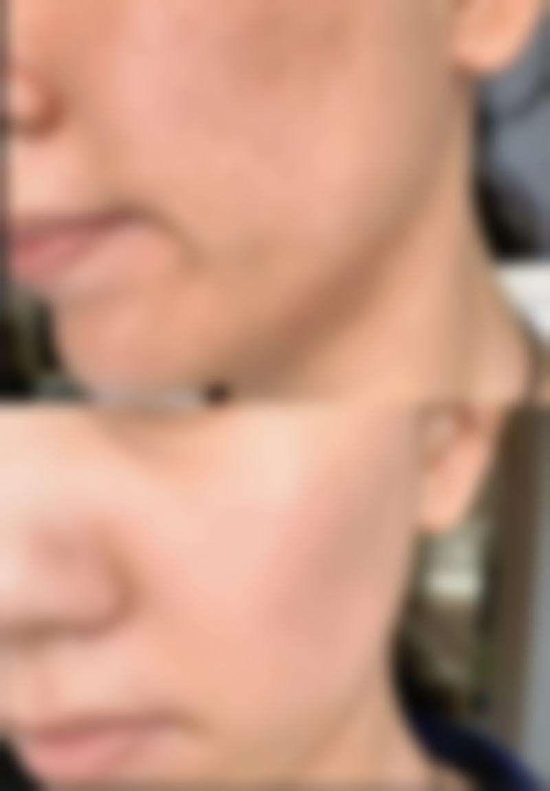 张汉东医生技术特点