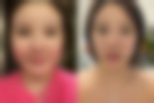 如何判断做完线提升后是否可以做面部吸脂