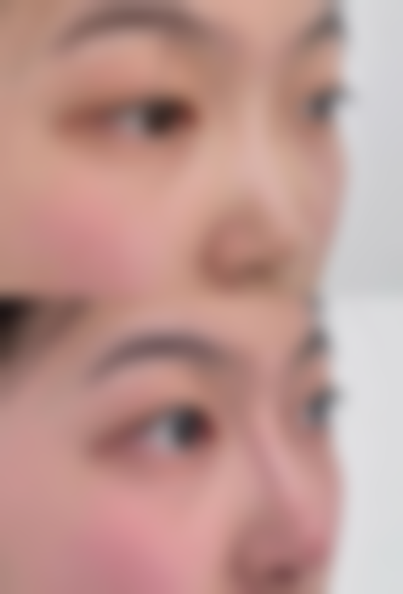 宁波鄞州宸沐整形医院真实实例：见证美丽的蜕变