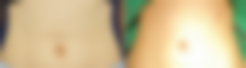 疤痕增生和正常疤痕怎么区分