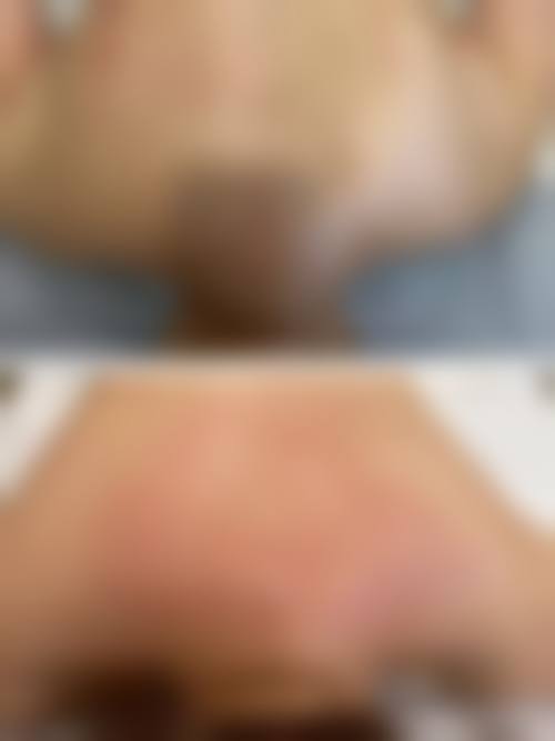 无锡宜兴华星医疗美容真实实例