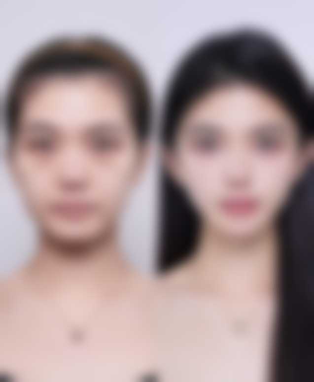 修复全切双眼皮疤痕还有其他方法吗