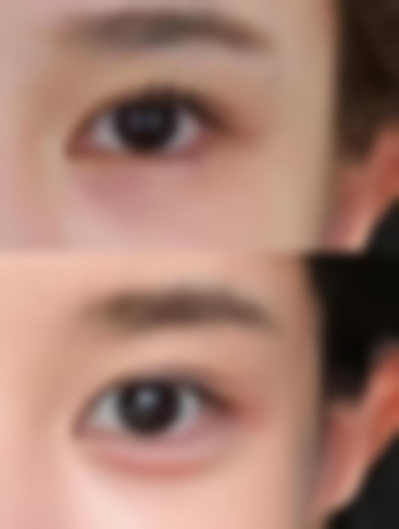 少女阴道紧缩非手术疗法靠谱吗